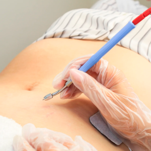 Galvano Puntura Zona Pequeña 10x10 a 15x15cm