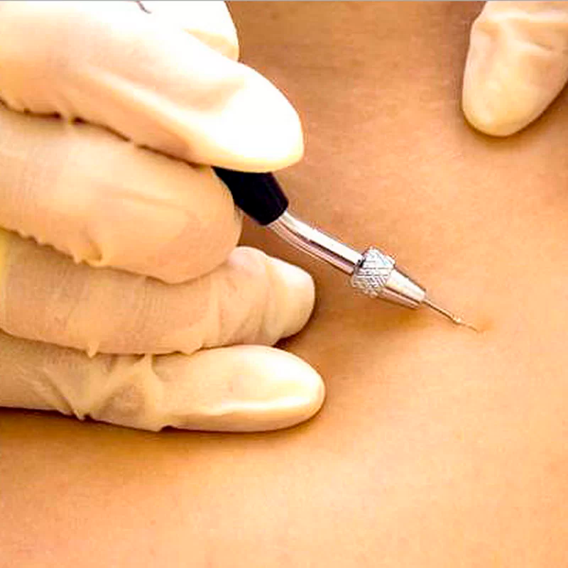 Galvano Puntura Zona Amplia 20x20cm